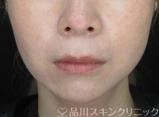 症例NO.70266のAFTER写真