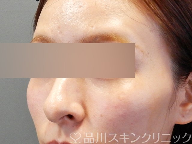 症例NO.67974のAFTER写真