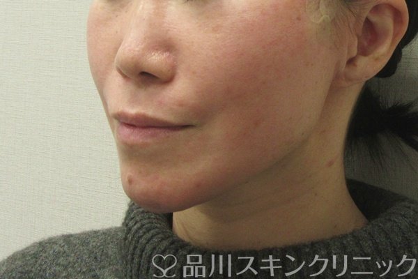 症例NO.75393のAFTER写真