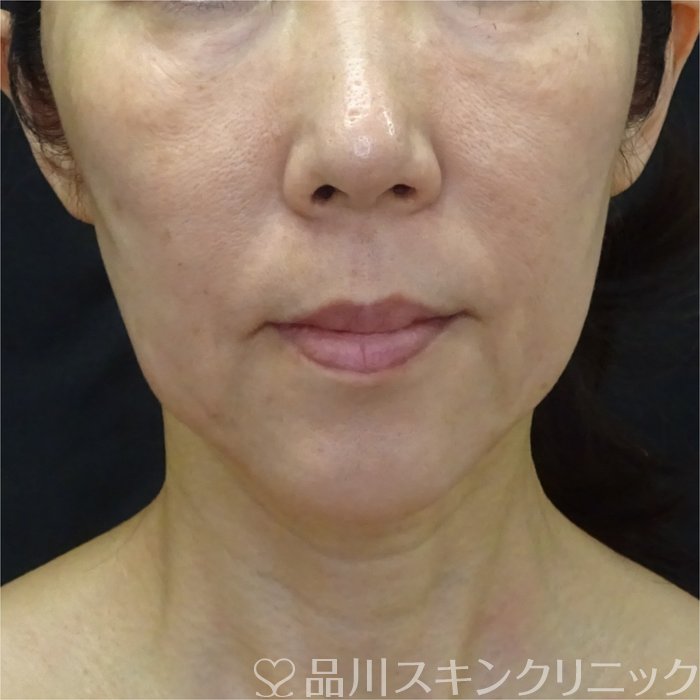 症例NO.71173のBEFORE写真