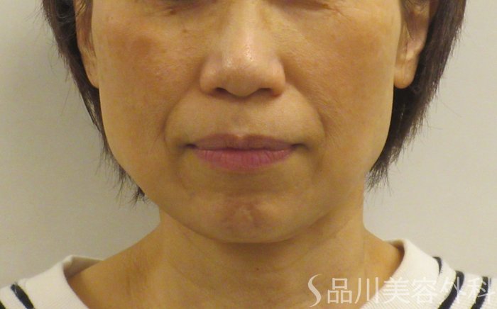 症例NO.71078のBEFORE写真