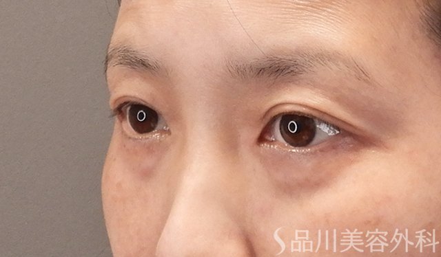 症例NO.75041のBEFORE写真