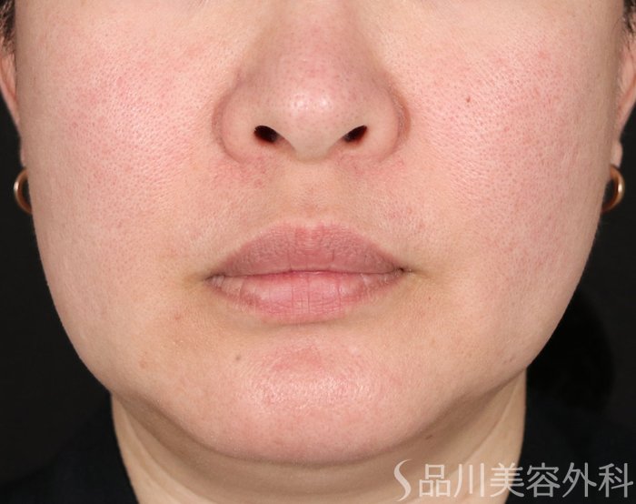 症例NO.71063のBEFORE写真