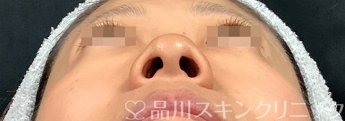 症例NO.67914のBEFORE写真