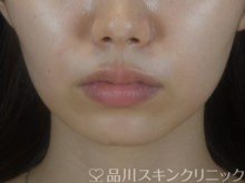症例NO.74377のBEFORE写真