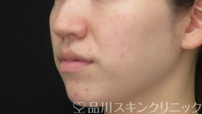 症例NO.71780のBEFORE写真