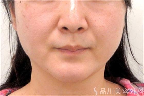 症例NO.13486のAFTER写真