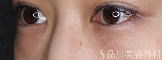 症例NO.72963のBEFORE写真