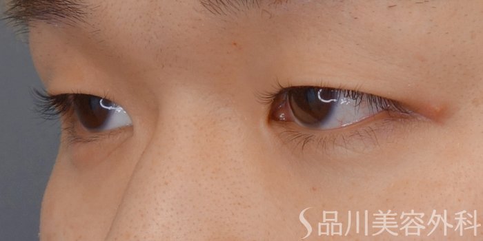 症例NO.72581のBEFORE写真