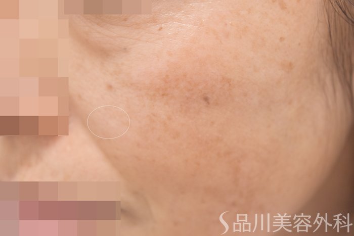 症例NO.64778のAFTER写真