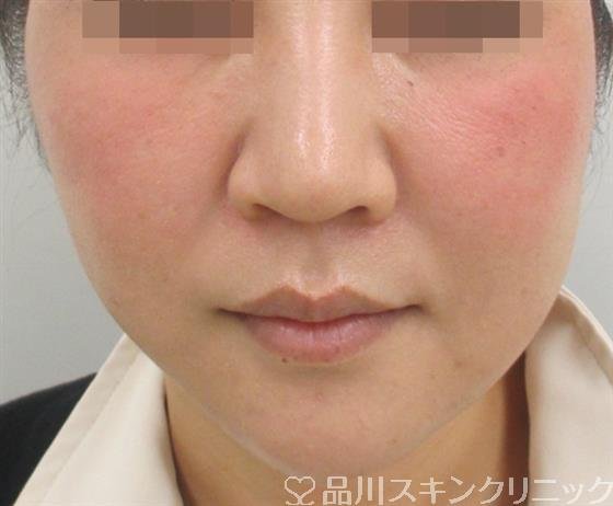 症例NO.27689のAFTER写真