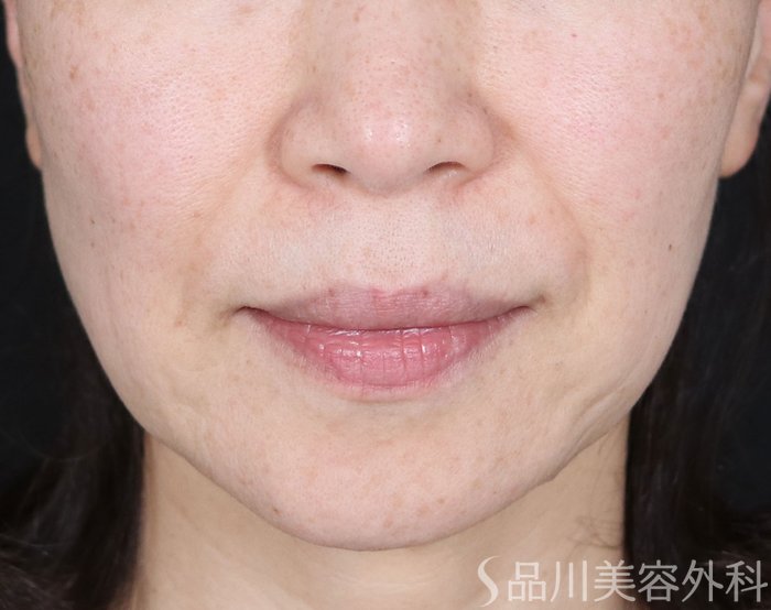 症例NO.71579のBEFORE写真