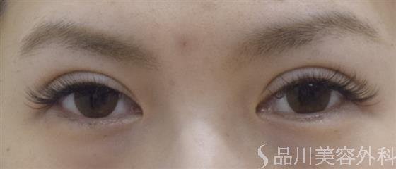 症例NO.52538のAFTER写真