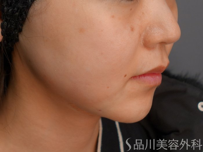 症例NO.75195のAFTER写真