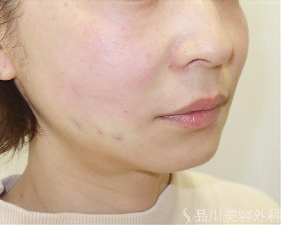 症例NO.41059のAFTER写真