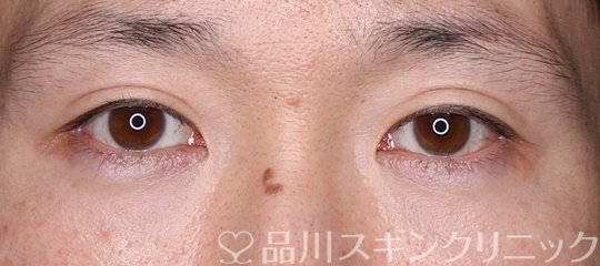 症例NO.74596のAFTER写真