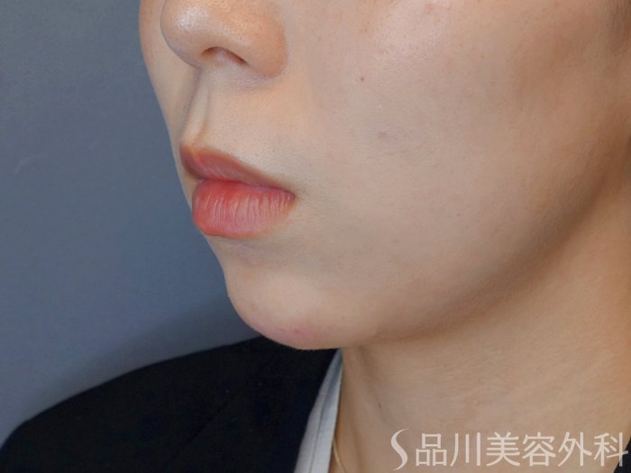 症例NO.74105のAFTER写真