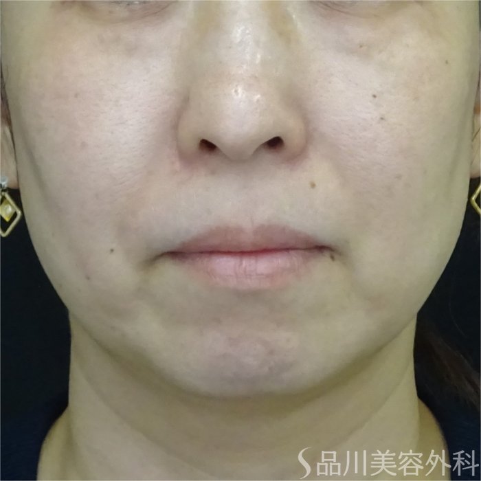 症例NO.70775のBEFORE写真