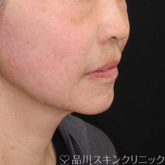 症例NO.75086のAFTER写真