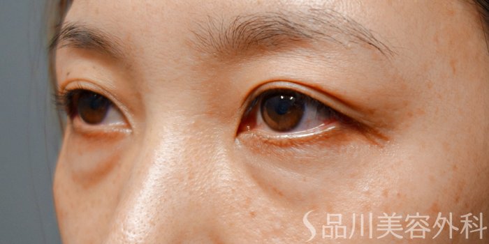 症例NO.73568のBEFORE写真