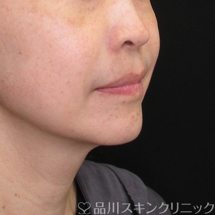 症例NO.75086のBEFORE写真
