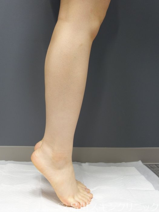 症例NO.73247のAFTER写真