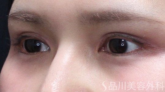 症例NO.75188のAFTER写真
