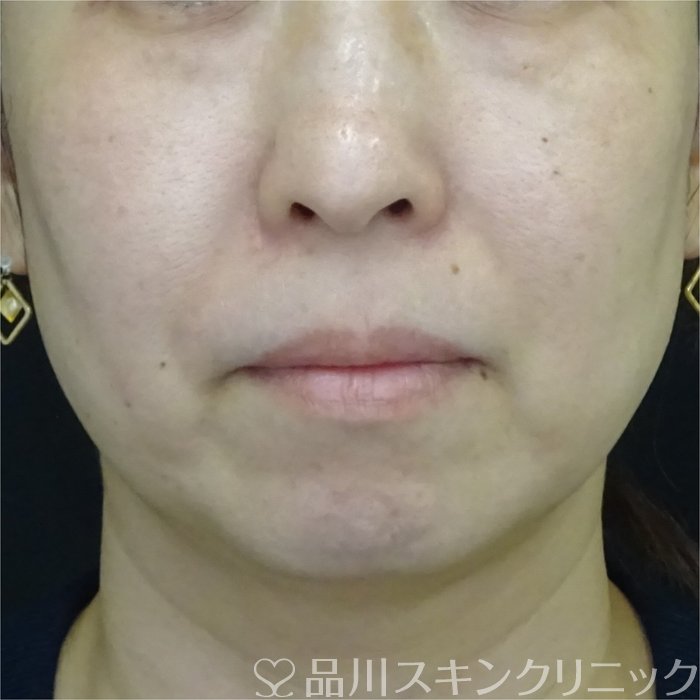 症例NO.70775のBEFORE写真