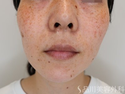 症例NO.74173のBEFORE写真