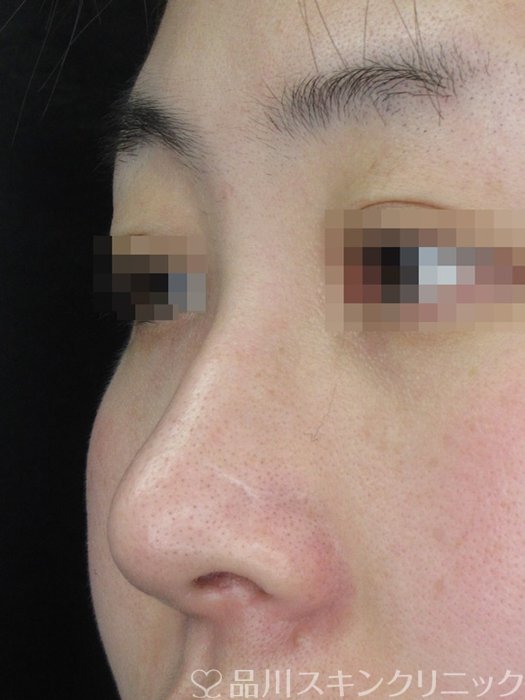 症例NO.69203のBEFORE写真