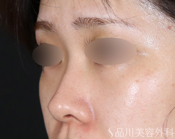 症例NO.71435のBEFORE写真