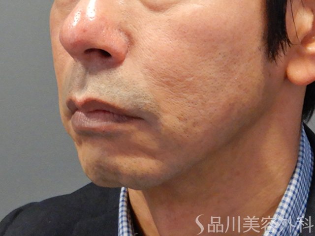 症例NO.73876のAFTER写真