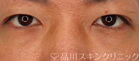 症例NO.72655のBEFORE写真