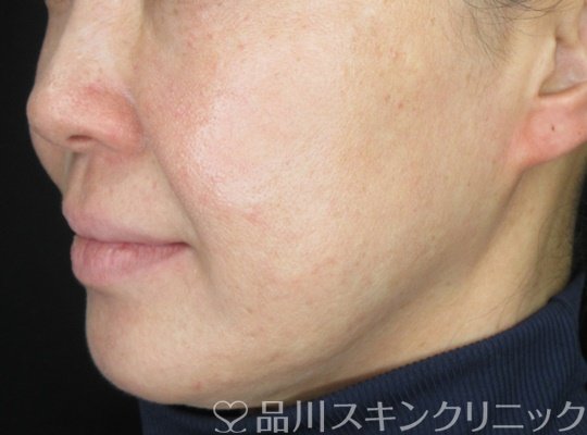 症例NO.70077のAFTER写真
