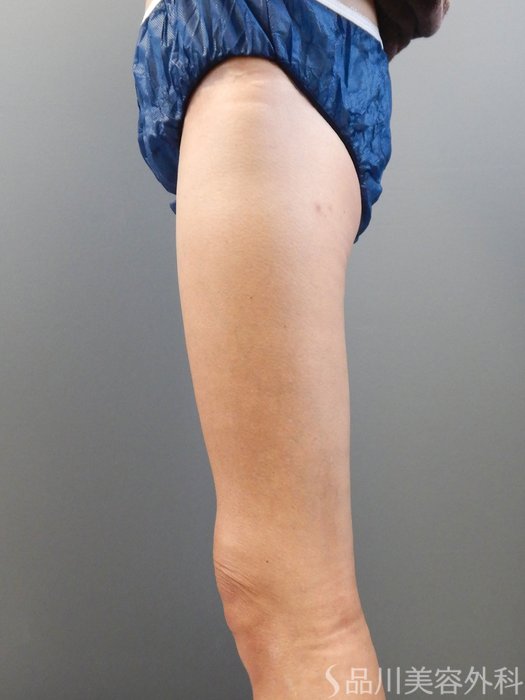 症例NO.71076のBEFORE写真