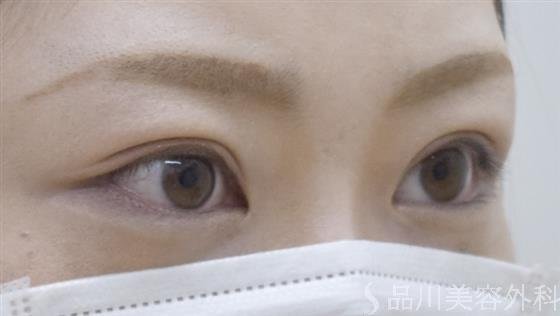 症例NO.53301のAFTER写真