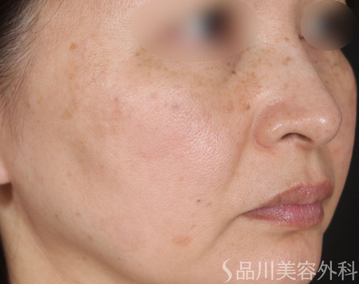 症例NO.73498のAFTER写真