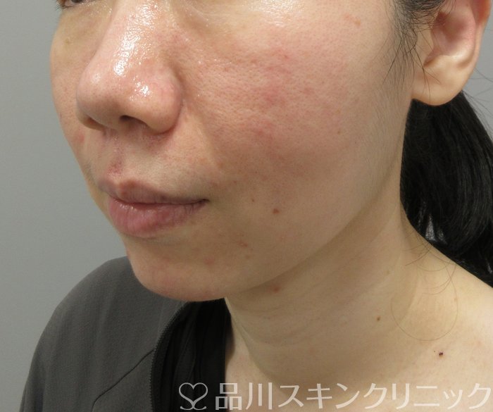 症例NO.73091のAFTER写真