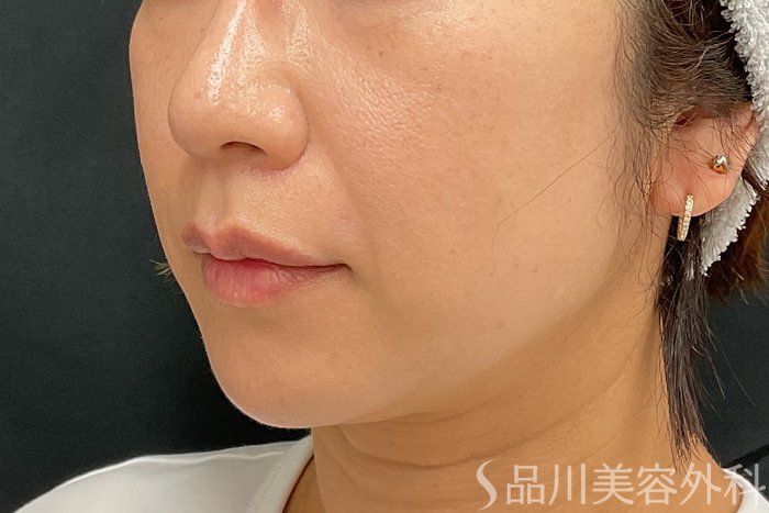 症例NO.73312のAFTER写真