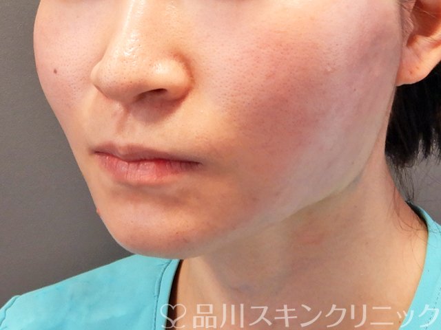 症例NO.70315のAFTER写真