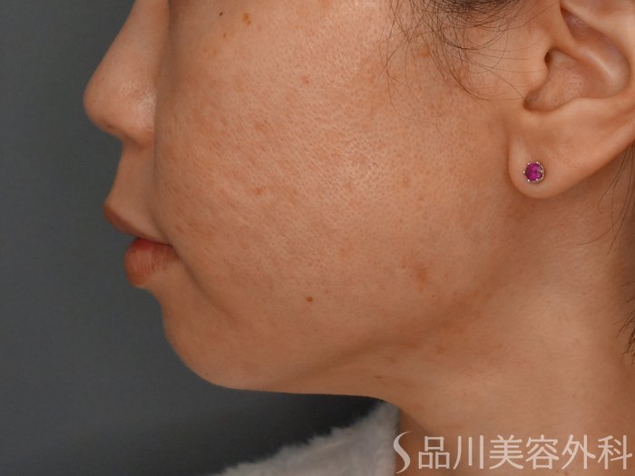 症例NO.73246のAFTER写真