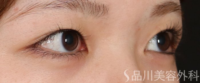 症例NO.71530のBEFORE写真
