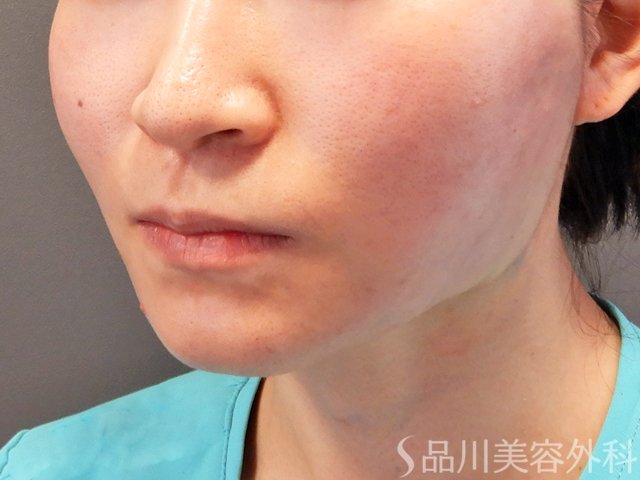 症例NO.70315のAFTER写真