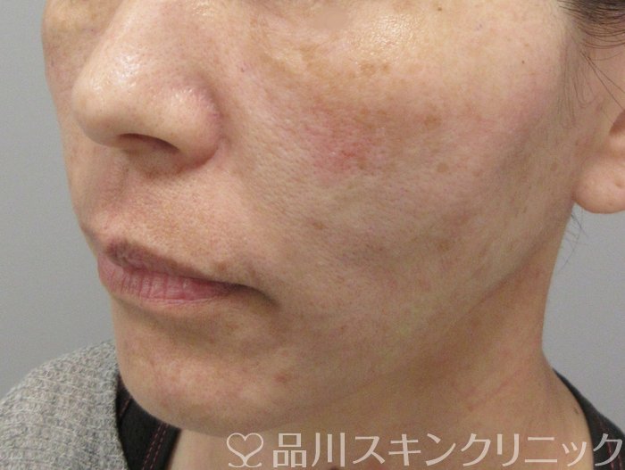 症例NO.70671のAFTER写真