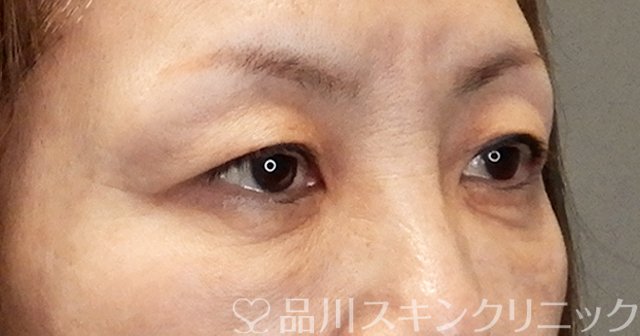 症例NO.65484のBEFORE写真