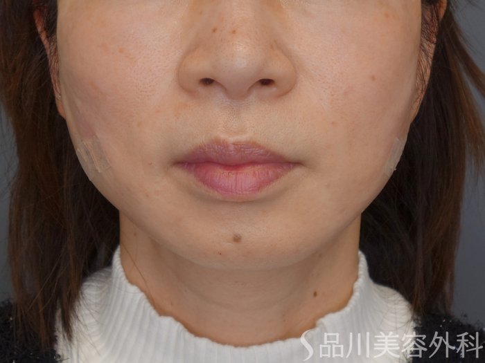 症例NO.72873のAFTER写真