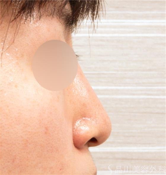 症例NO.53150のAFTER写真