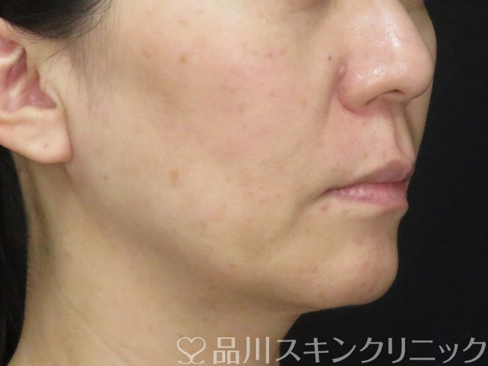 症例NO.69053のBEFORE写真