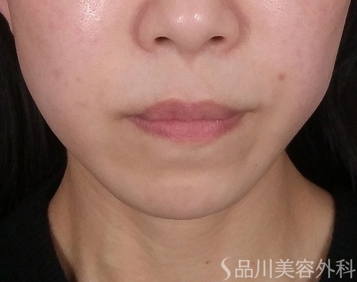 症例NO.69800のBEFORE写真