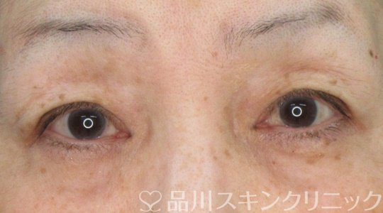 症例NO.70634のAFTER写真